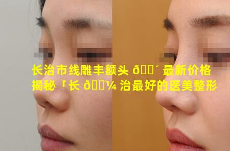 长治市线雕丰额头 🌴 最新价格揭秘「长 🐼 治最好的医美整形医院」